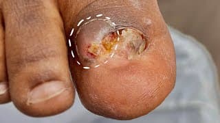 What is HIDING INSIDE this INFECTED TOE?!?!