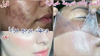 secret japonais pour paraître 10 ans plus jeune que votre âge ,traitement anti-âge anti-ride,botox