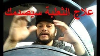 علاج الثعلبة : علاج قديم وغريب يقضي في 3 ايام علي داء مرض ثعلبة الشعر  عند الاطفال او الكبار
