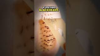 Get Rid Of Black Heads With An Egg Mask