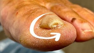 The Pressure Inside This Ingrown Toenail… WOW